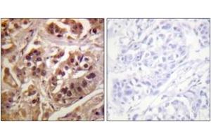 Immunohistochemistry analysis of paraffin-embedded human lung carcinoma tissue, using IKK-gamma (Ab-31) Antibody. (IKBKG antibody  (AA 16-65))