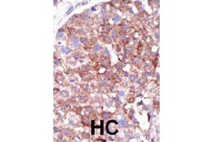 Formalin-fixed and paraffin-embedded human hepatocellular carcinoma tissue reacted with SMURF1 polyclonal antibody  , which was peroxidase-conjugated to the secondary antibody, followed by DAB staining. (SMURF1 antibody  (C-Term))