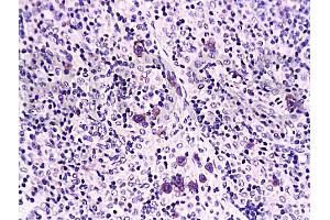 Formalin-fixed and paraffin embedded rat transplant lymphoma labeled with Anti-Caspase-1 Polyclonal Antibody, Unconjugated (ABIN725780) at 1:200 followed by conjugation to the secondary antibody and DAB staining (Caspase 1 (p10) antibody  (AA 320-404))