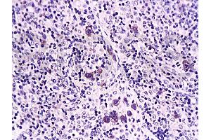 Formalin-fixed and paraffin embedded rat transplant lymphoma labeled with Anti-Caspase-1 Polyclonal Antibody, Unconjugated (ABIN725780) at 1:200 followed by conjugation to the secondary antibody and DAB staining (Caspase 1 (p10) antibody  (AA 320-404))