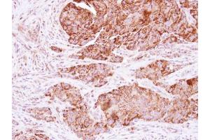 IHC-P Image Immunohistochemical analysis of paraffin-embedded human colon carcinoma, using KNP-I, antibody at 1:250 dilution. (KNP-1 (Center) antibody)
