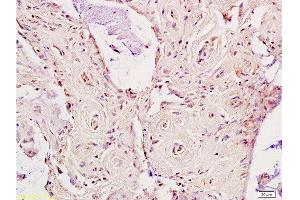 Formalin-fixed and paraffin embedded human rectal carcinoma labeled Anti-LDL receptor Polyclonal Antibody, Unconjugated  at 1:200, followed by conjugation to the secondary antibody and DAB staining (LDLR antibody  (AA 781-860))