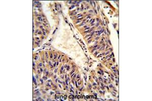 Formalin-fixed and paraffin-embedded human lung carcinoma reacted with ALG14 Antibody , which was peroxidase-conjugated to the secondary antibody, followed by DAB staining.