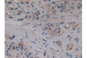 DAB staining on IHC-P; Samples: Human Prostate cancer Tissue (ALOX15B antibody  (AA 253-490))