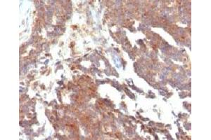 IHC testing of FFPE human ovarian carcinoma and GnRHR antibody (clone LCHR37) (GNRHR antibody)