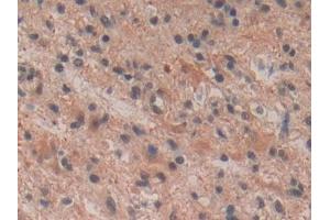 DAB staining on IHC-P; Samples: Human Glioma Tissue (Tachykinin 3 antibody  (AA 23-121))
