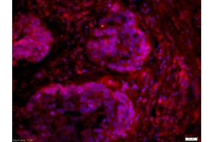 Formalin-fixed and paraffin embedded human lung carcinoma labeled with Anti-RAB4 Polyclonal Antibody, Unconjugated (ABIN763256) at 1:200 followed by conjugation to the secondary antibody Goat Anti-Rabbit IgG, Cy3 conjugated used at 1:200 dilution for 40 minutes at 37°C and DAPI staining (Rab4 antibody  (AA 21-120))