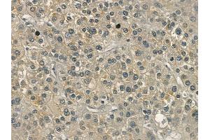 ABIN6259185 and ABIN6274510 at 1/100 staining human hepatocellular carcinoma by IHC-P.