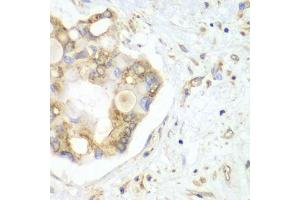 Immunohistochemistry of paraffin-embedded human liver cancer using VTI1B antibody. (VTI1B antibody)