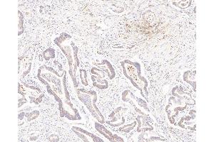 Immunohistochemistry analysis of paraffin-embedded human colon cancer using MMP2 Polyclonal Antibody at dilution of 1:500. (MMP2 antibody)