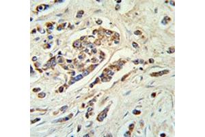 ABCC11 antibody IHC analysis in formalin fixed and paraffin embedded breast carcinoma. (ABCC11 antibody  (AA 343-372))