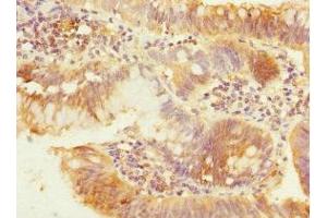 Immunohistochemistry of paraffin-embedded human colon cancer using ABIN7162961 at dilution of 1:100 (PEX19 antibody  (AA 1-299))