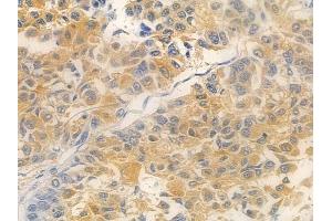 ABIN7095030 and ABIN7099086 at 1/100 staining human lung squamous cell carcinoma by IHC-P. (TMEM199 antibody)