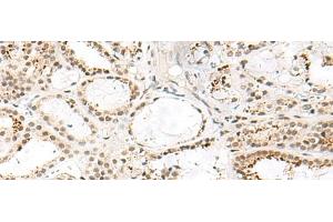 Immunohistochemistry of paraffin-embedded Human thyroid cancer tissue using FKBP5 Polyclonal Antibody at dilution of 1:50(x200) (FKBP5 antibody)