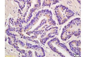 Formalin-fixed and paraffin embedded human colon carcinoma labeled with Anti-P2RX3/ATP receptor Polyclonal Antibody, Unconjugated  at 1:200 followed by conjugation to the secondary antibody and DAB staining. (P2RX3 antibody  (AA 241-340))