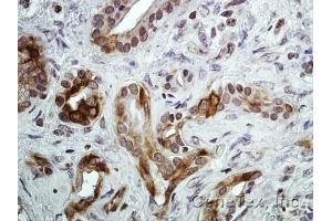 IHC-P Image Immunohistochemical analysis of paraffin-embedded Human pancreatic tumor, using CXCR7, antibody at 1:100 dilution. (CXCR7 antibody)