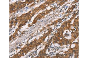 Immunohistochemistry of Human thyroid cancer using DSC2 Polyclonal Antibody at dilution of 1:35
