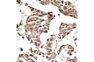 Formalin-fixed and paraffin-embedded human cancer tissue reacted with the primary antibody, which was peroxidase-conjugated to the secondary antibody, followed by AEC staining. (ATG4C antibody  (N-Term))