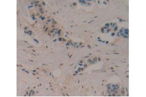 IHC-P analysis of Human Breast Cancer Tissue, with DAB staining. (ENO2/NSE antibody  (AA 1-434))