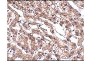 Immunohistochemistry of MACC1 in human liver tissue with this product at 2. (MACC1 antibody  (Center))