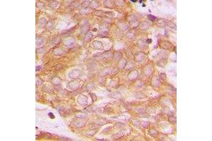 Immunohistochemical analysis of BEGAIN staining in human breast cancer formalin fixed paraffin embedded tissue section.
