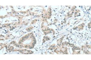 Immunohistochemistry of paraffin-embedded Human colon cancer tissue using ASH2L Polyclonal Antibody at dilution 1:60 (ASH2L antibody)