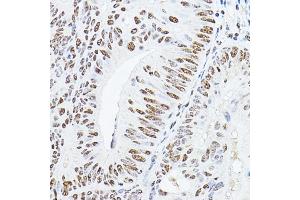 Immunohistochemistry of paraffin-embedded human colon carcinoma using YE Rabbit pAb (ABIN6130808, ABIN6150331, ABIN6150332 and ABIN6221925) at dilution of 1:100 (40x lens). (GAS41 antibody  (AA 1-227))