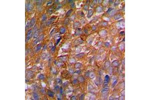 Immunohistochemical analysis of c-CBL (pY774) staining in human breast cancer formalin fixed paraffin embedded tissue section. (CBL antibody  (C-Term, pTyr774))