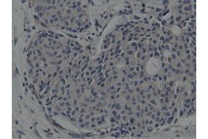 Immunohistochemical staining of paraffin-embedded Adenocarcinoma of Human breast tissue using anti-SH3GL1 mouse monoclonal antibody. (SH3GL1 antibody)