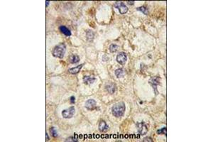 Formalin-fixed and paraffin-embedded human hepatocarcinoma tissue reacted with SSR1 antibody , which was peroxidase-conjugated to the secondary antibody, followed by DAB staining.