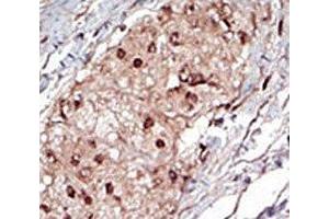 IHC analysis of FFPE human hepatocarcinoma tissue stained with the SPHK1 antibody (SPHK1 antibody  (AA 286-315))