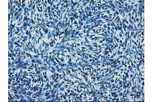 Immunohistochemical staining of paraffin-embedded Adenocarcinoma of colon tissue using anti-ERCC1 mouse monoclonal antibody. (ERCC1 antibody)