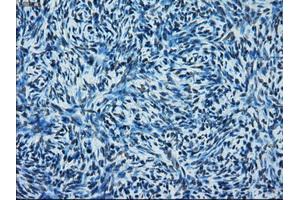 Immunohistochemical staining of paraffin-embedded Adenocarcinoma of colon tissue using anti-ERCC1 mouse monoclonal antibody.