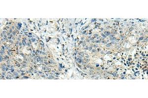 Immunohistochemistry of paraffin-embedded Human cervical cancer tissue using PAK1IP1 Polyclonal Antibody at dilution of 1:120(x200) (PAK1IP1 antibody)