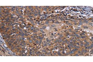 Immunohistochemistry of paraffin-embedded Human cervical cancer tissue using LRRC15 Polyclonal Antibody at dilution 1:60 (LRRC15 antibody)
