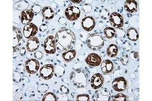 Immunohistochemical staining of paraffin-embedded Carcinoma of pancreas tissue using anti-IFT57 mouse monoclonal antibody. (IFT57 antibody)