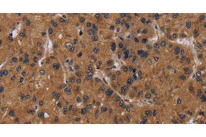 Immunohistochemistry of paraffin-embedded Human liver cancer tissue using NPRL2 Polyclonal Antibody at dilution 1:50 (NPRL2 antibody)