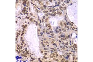 Immunohistochemistry of paraffin-embedded human oophoroma using POLD3 antibody. (POLD3 antibody  (AA 197-466))