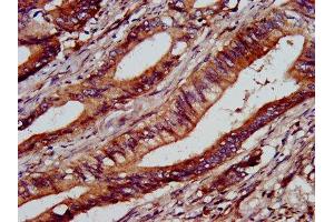 IHC image of ABIN7154230 diluted at 1:1000 and staining in paraffin-embedded human colon cancer performed on a Leica BondTM system. (C1GALT1 antibody  (AA 34-143))