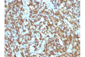 Formalin-fixed, paraffin-embedded human Lymphoma stained with CD45RO Monoclonal Antibody (SPM125). (CD45 antibody)
