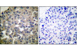 Immunohistochemical analysis of paraffin-embedded human breast carcinoma tissue using PLCG1 (Ab-771) antibody. (Phospholipase C gamma 1 antibody)