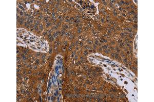 Immunohistochemistry of Human lung cancer using JUP Polyclonal Antibody at dilution of 1:40 (JUP antibody)