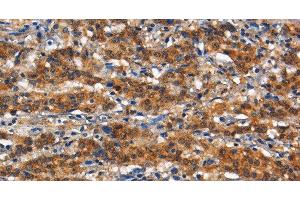 Immunohistochemistry of paraffin-embedded Human gasrtic cancer tissue using CD13 Polyclonal Antibody at dilution 1:80 (CD13 antibody)