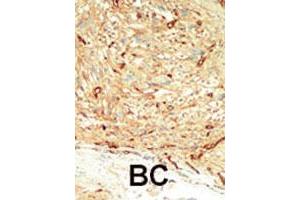 Formalin-fixed and paraffin-embedded human cancer tissue reacted with the STK4 polyclonal antibody  , which was peroxidase-conjugated to the secondary antibody, followed by DAB staining. (STK4 antibody  (C-Term))