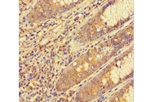 Immunohistochemistry of paraffin-embedded human colon cancer using ABIN7153793 at dilution of 1:100 (GTF2F1 antibody  (AA 1-249))