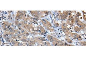 Immunohistochemistry of paraffin-embedded Human breast cancer tissue using CXCL5 Polyclonal Antibody at dilution of 1:45(x200) (CXCL5 antibody)
