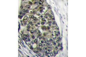 Formalin-fixed and paraffin-embedded human breast carcinoma tissue reacted with LRP6 Antibody (C-term ) (ABIN390100 and ABIN2840612) , which was peroxidase-conjugated to the secondary antibody, followed by DAB staining. (LRP6 antibody  (C-Term))