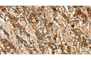 Immunohistochemistry of paraffin-embedded Human gastic cancer using CALR Polyclonal Antibody at dilution of 1:50 (Calreticulin antibody)