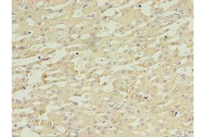 Immunohistochemistry of paraffin-embedded human liver cancer using ABIN7149554 at dilution of 1:100 (DAPK2 antibody  (AA 222-370))
