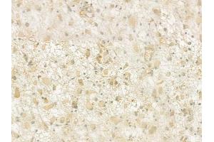 ABIN6261305 and ABIN6276929 at 1/100 staining human glioblastoma by IHC-P. (DKC1 antibody  (Internal Region))